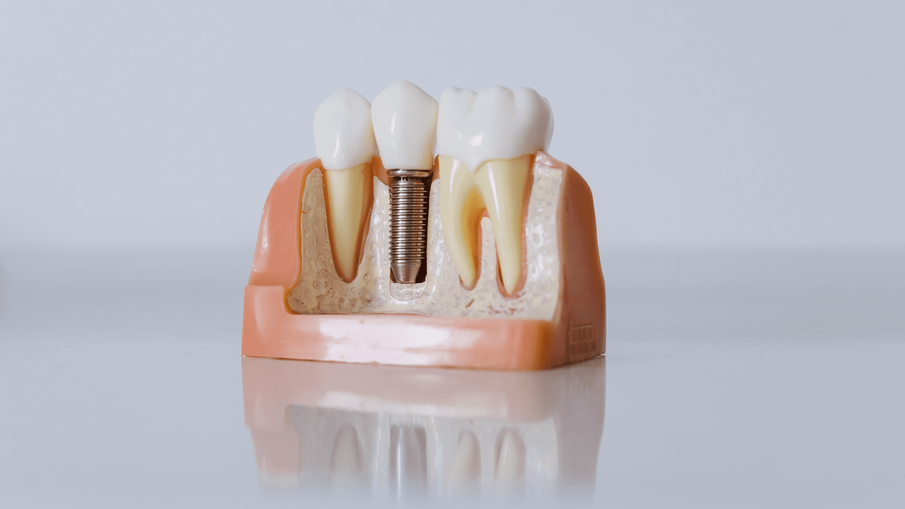 missing tooth being fixed with dental implants